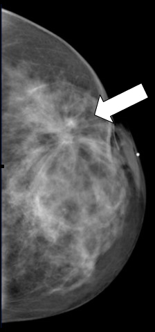 The patient’s mammogram after lumpectomy demonstrated a stellate area of tissue in the operative site.