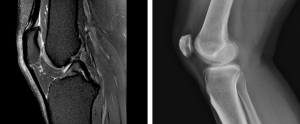 Lateral views of the knee. The left image is from a knee MRI. The right from an knee x-ray. Much more detail is available from the knee MRI.