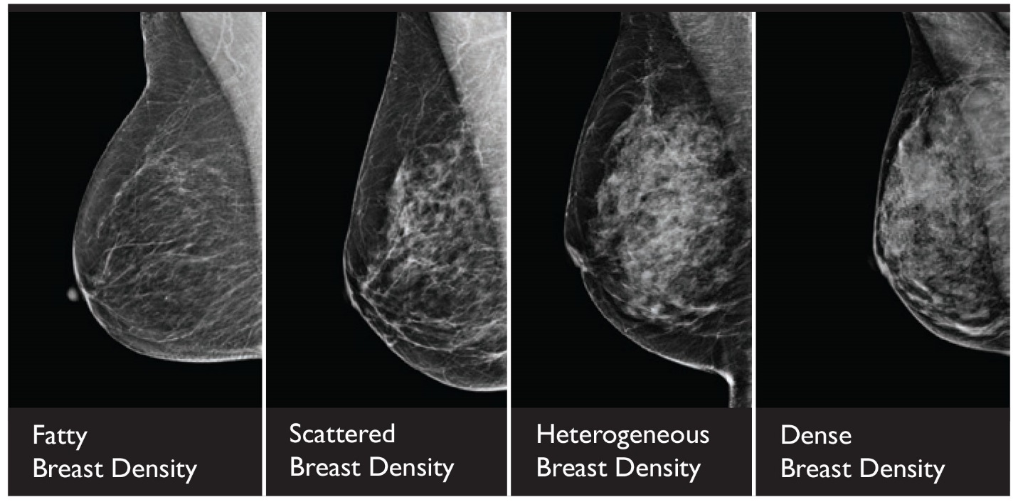 What Does It Really Mean To Have Dense Breasts?
