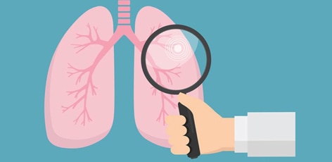 Should You Have a Lung Cancer Screening?